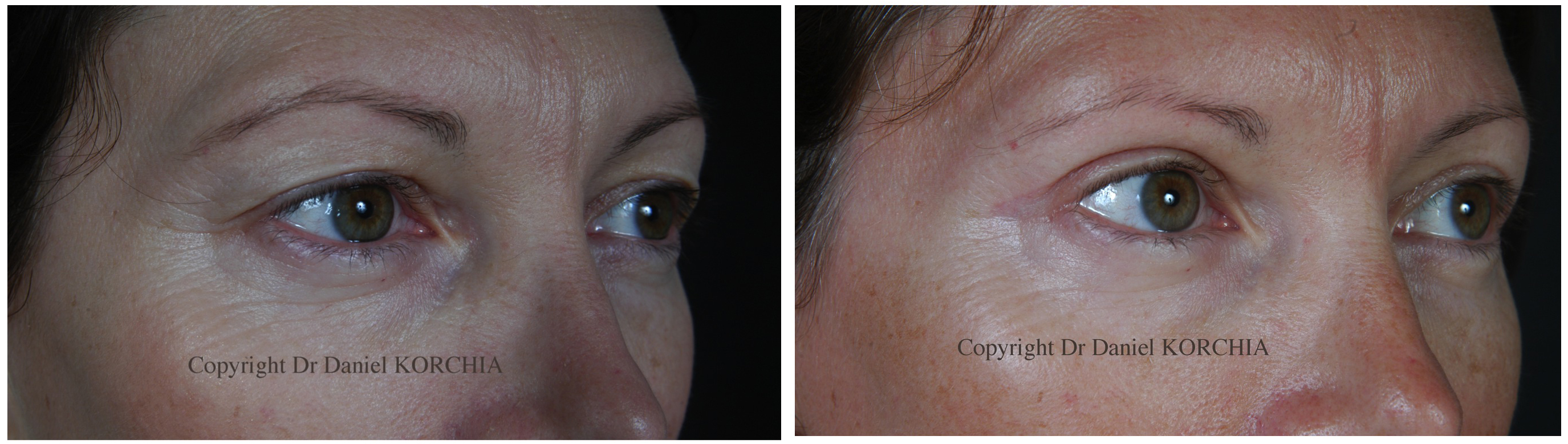 blépharoplastie