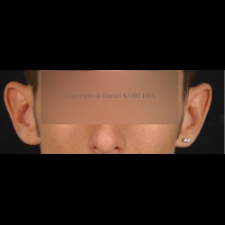 avant opération otoplastie