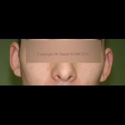 avant opération otoplastie