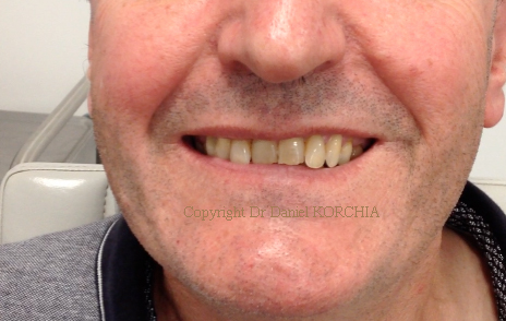 paralysie faciale et toxine botulique